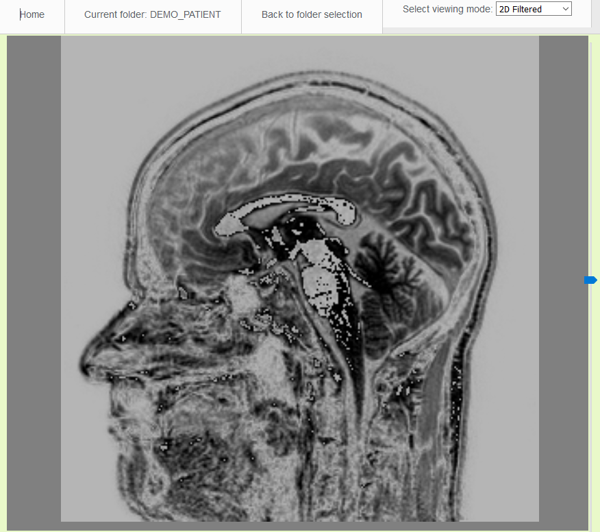 Vicomtech-IK4 takes part in the development of a virtual system for functional neurosurgery