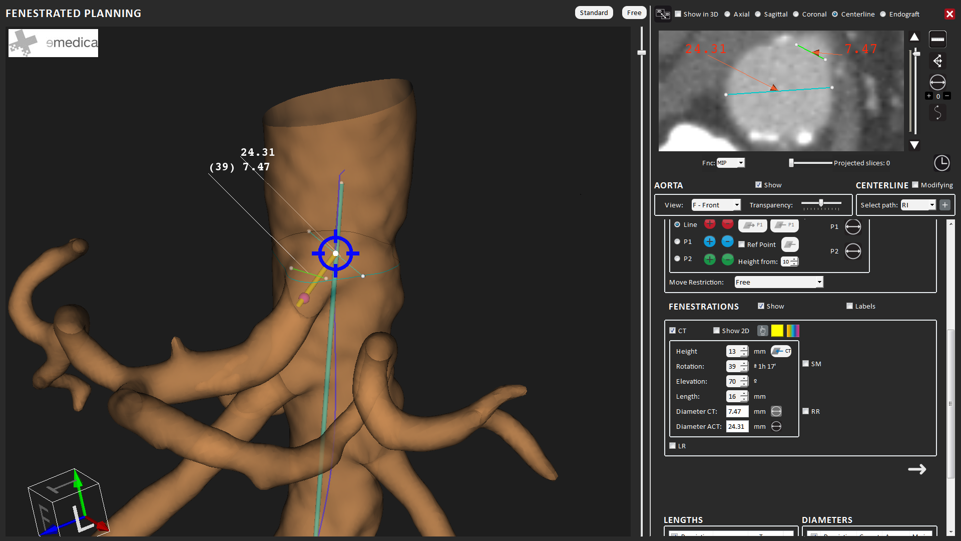 Development of a prosthesis system for aortic aneurysm