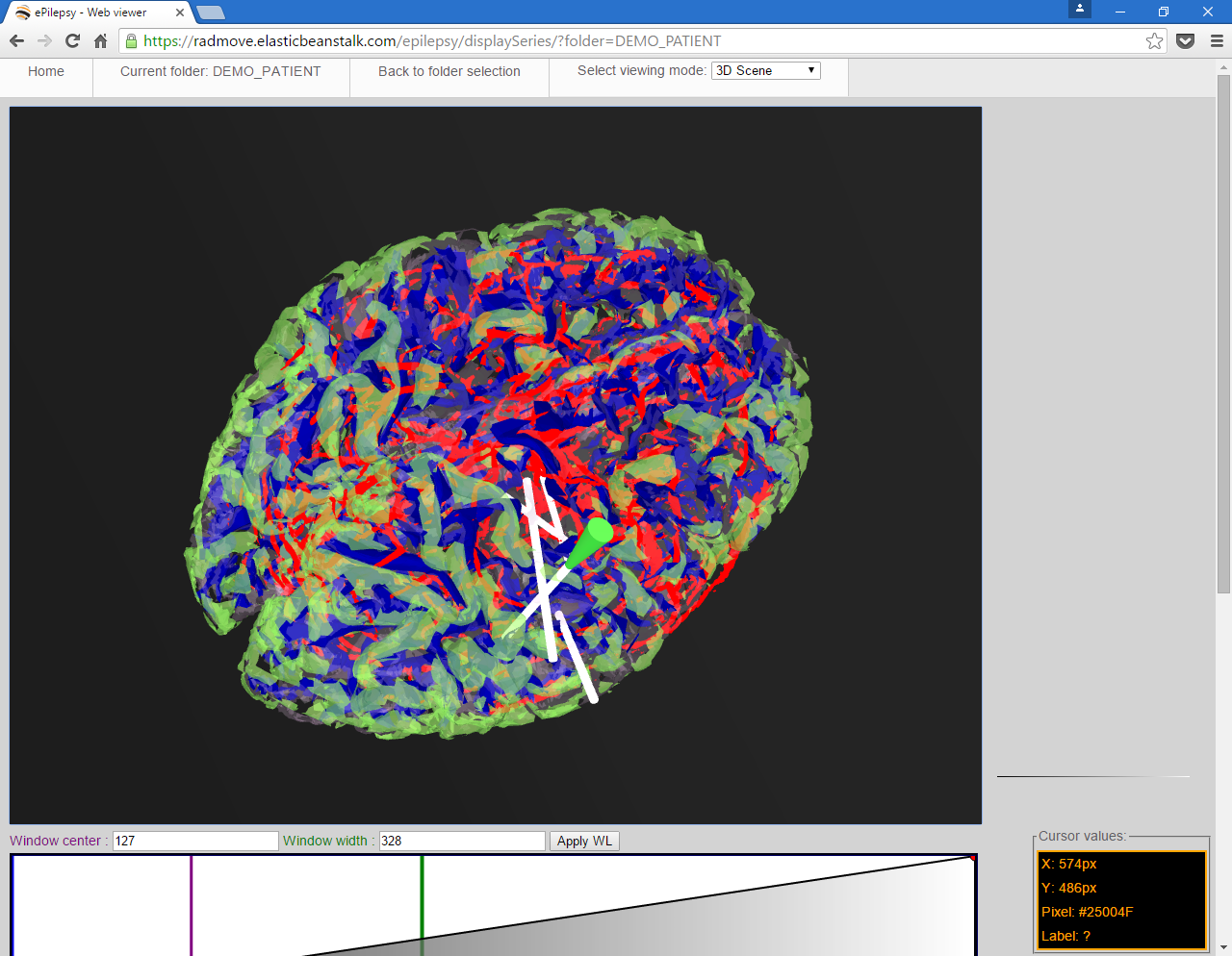 Vicomtech-IK4 takes part in the e-Pilepsy project together with Bilbomatica, ERESA and La Fe Health Research Institute