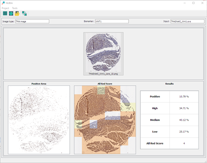 Personalised medicine: Development of diagnostic tools and cancer therapies